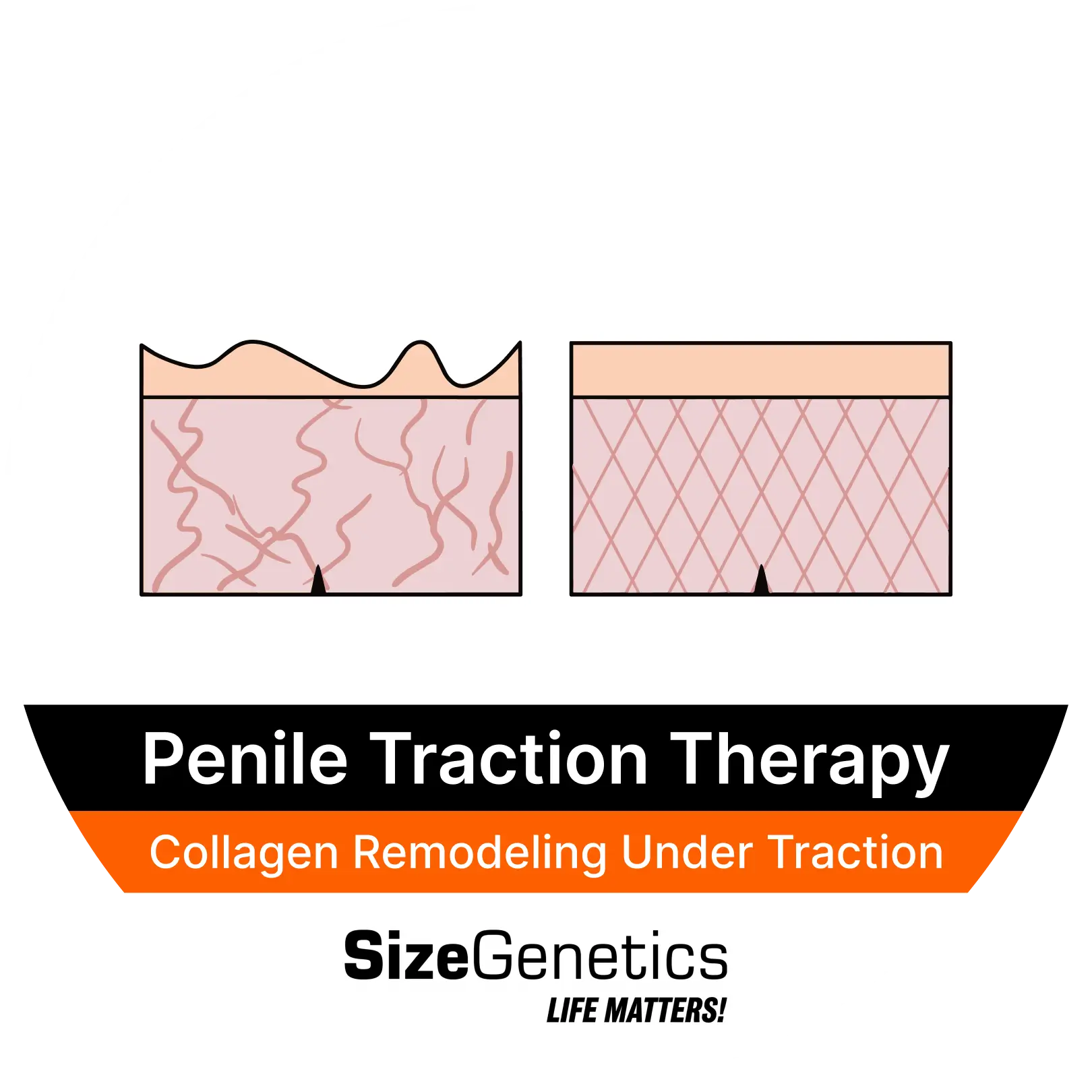 Collagen Remodeling Under Traction
