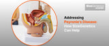 Addressing Peyronie's Disease: How SizeGenetics Can Help