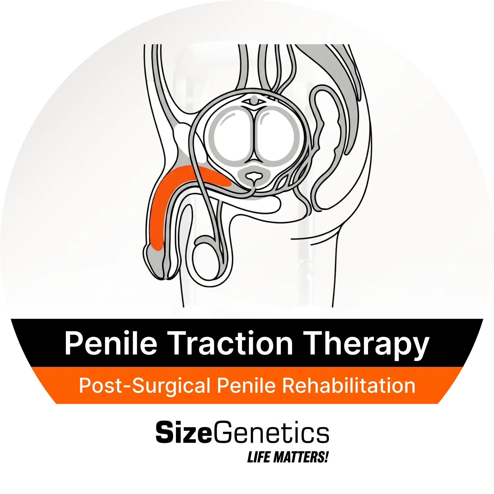 Post-Surgical Penile Rehabilitation with Medical Traction Therapy