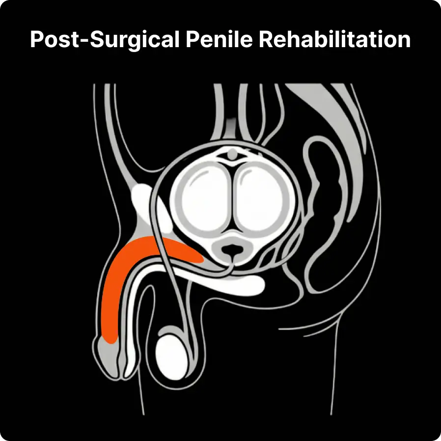 Post-Surgical Penile Rehabilitation with Medical Traction Therapy