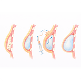 How Tissue Expansion Works in Medicine: From Burn Treatment to Penile Traction